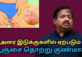 அரை இடுக்குகளில் ஏற்படும் பூஞ்சை தொற்று குணமாக இயற்கை வைத்தியம் | Dr.Sivaraman-Fungal infection