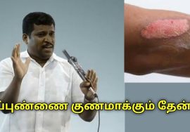 தீப்புண் குணமாக தேன் பூசுங்க | Healer Baskar speech on remedy for fire burns